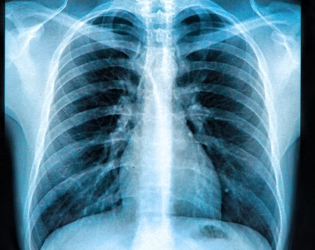 X-Ray